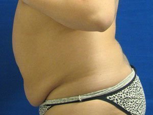 Smart Liposuction Before & After case 7