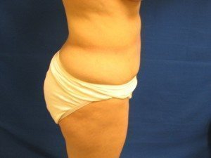 Smart Liposuction Before & After case 8