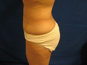 Smart Liposuction Before & After case 8