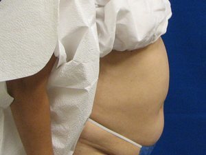 Smart Liposuction Before & After case 9