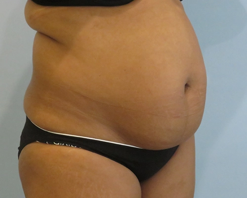 Smart Liposuction Before & After