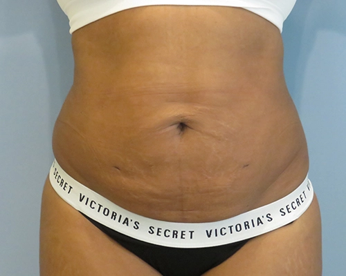 Smart Liposuction | Liposuction Before & After case 2