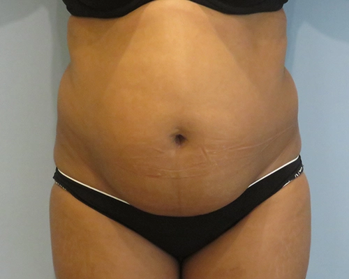 Smart Liposuction | Liposuction Before & After case 2