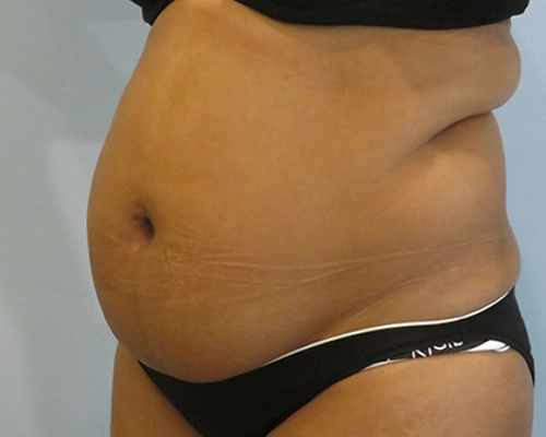 Smart Liposuction | Liposuction Before & After case 2