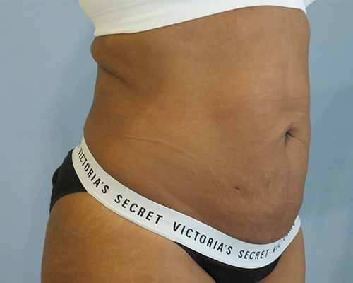 Smart Liposuction | Liposuction Before & After case 2