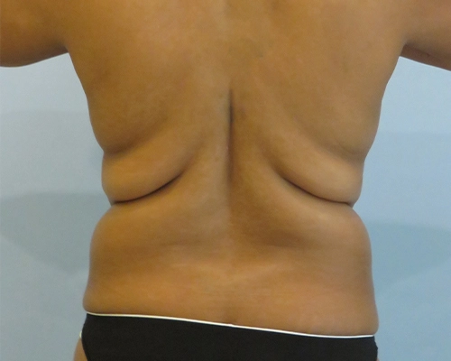 Smart Liposuction | Liposuction Before & After case 2