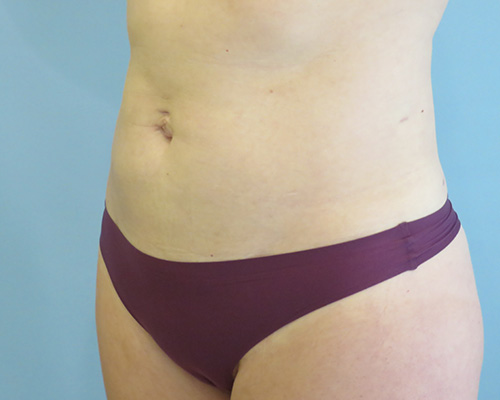 Smart Liposuction | Liposuction Before & After Case 3