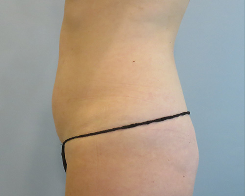 Smart Liposuction | Liposuction Before & After Case 3