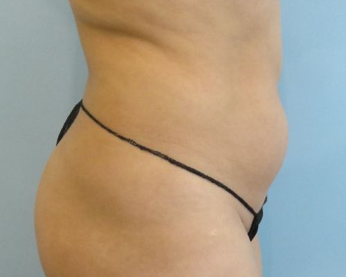 Smart Liposuction | Liposuction Case 1