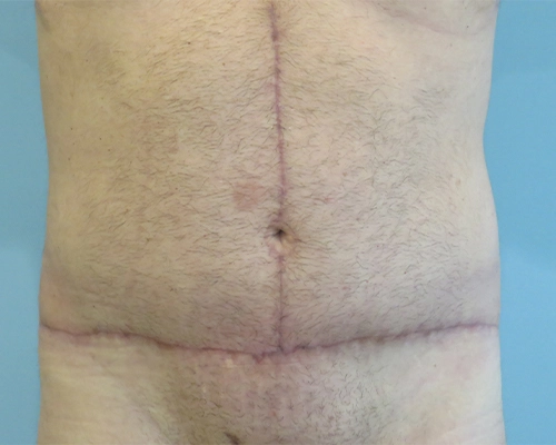 Tummy Tuck Before & After Case 1