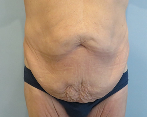 Tummy Tuck Before & After Case 1
