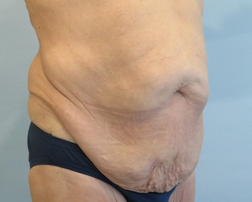 Tummy Tuck Before & After Case 1