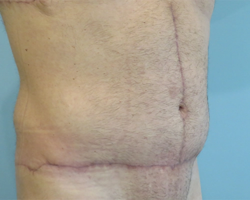 Tummy Tuck Before & After Case 1