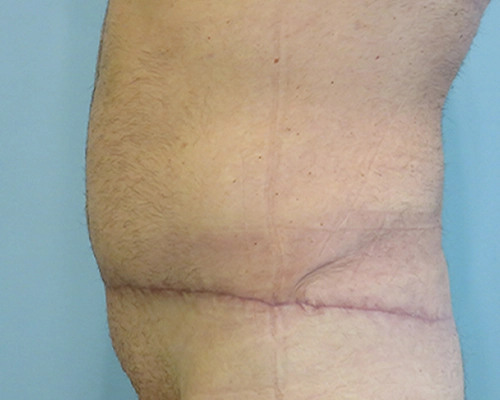 Tummy Tuck Before & After Case 1