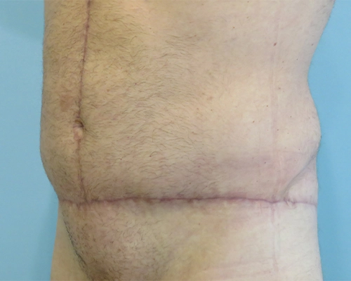 Tummy Tuck Before & After Case 1
