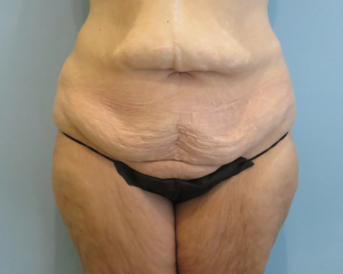 Tummy Tuck Before & After case 25