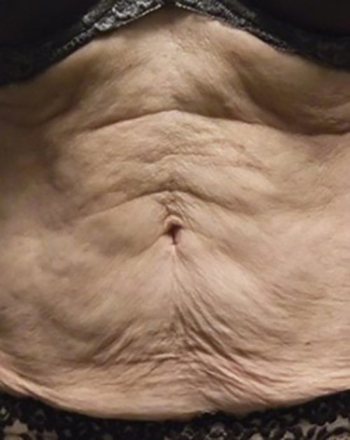 Venus Freeze Before & After Case 8