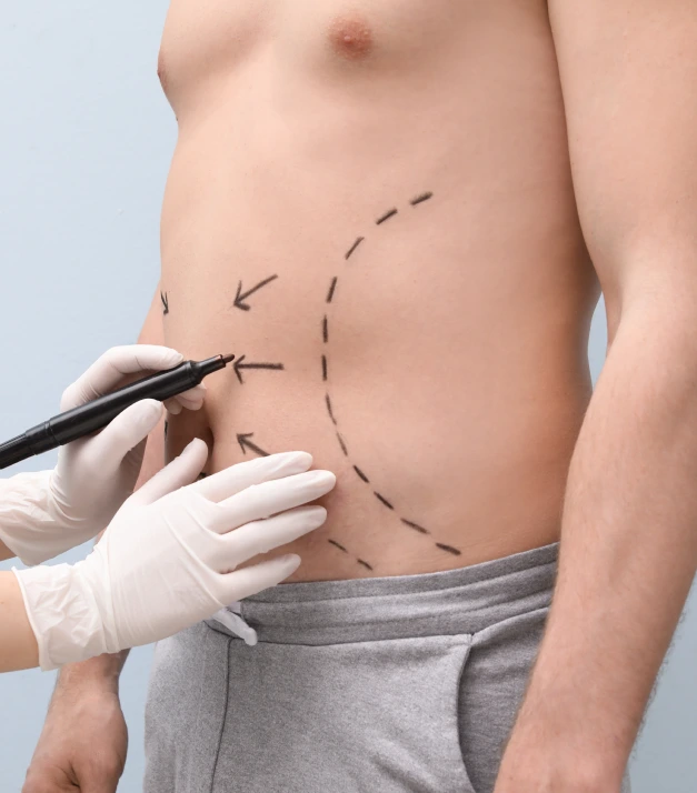 What Is Male Liposuction? Banner