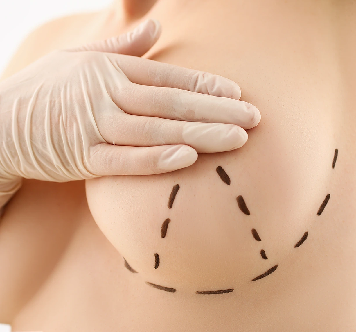 Breast Surgery Austin, Texas: Breast Lift (Mastopexy) Banner