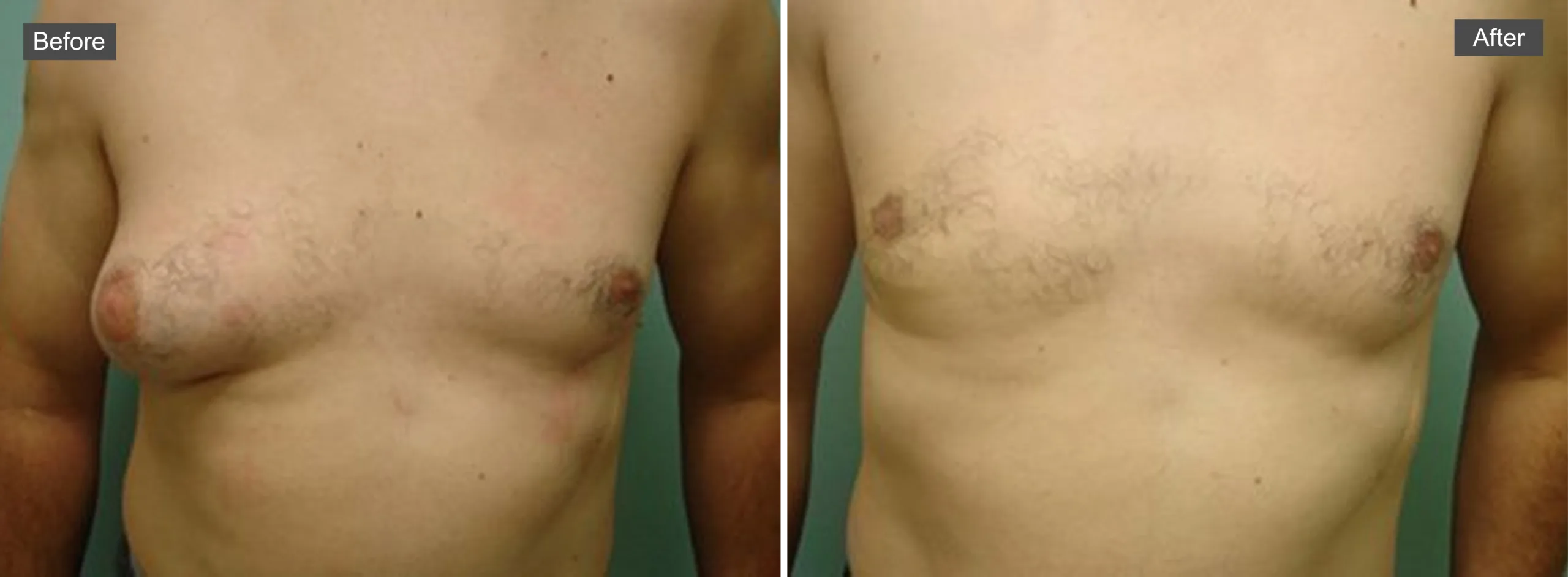 Before and after gynecomastia treatment showing reduced breast tissue and improved chest contour