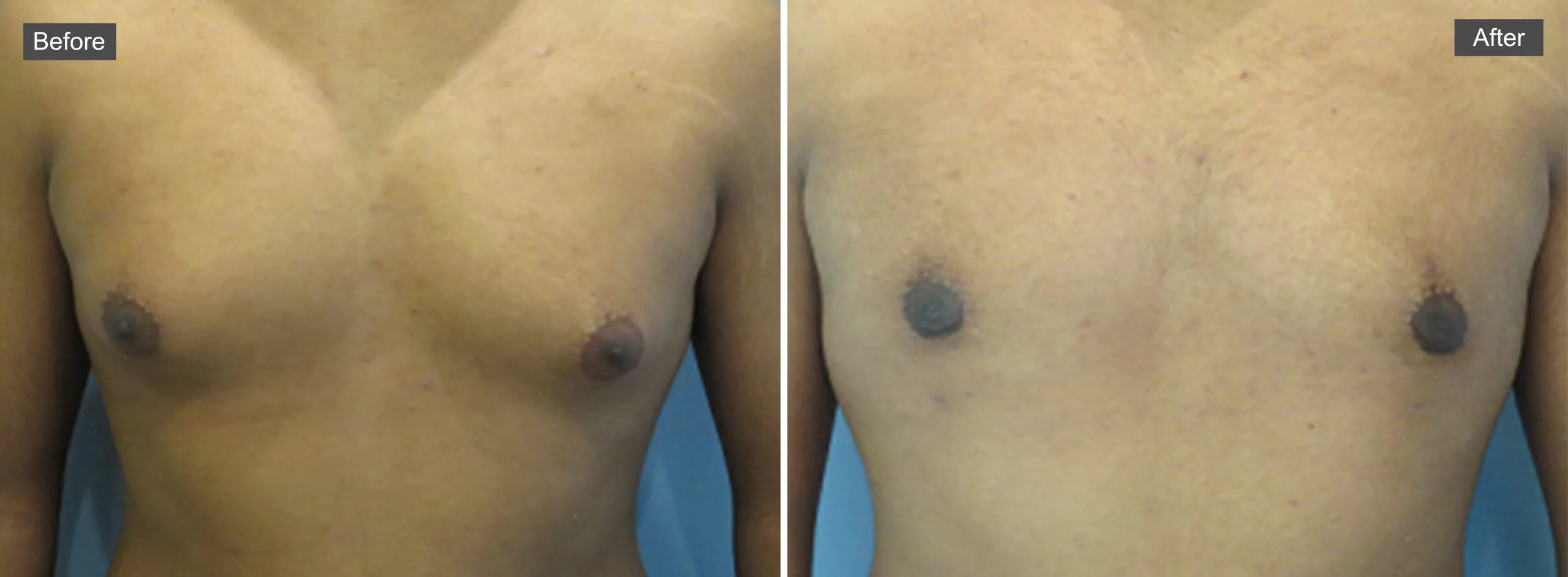 Before and after chest comparison showing reduction in gynecomastia appearance
