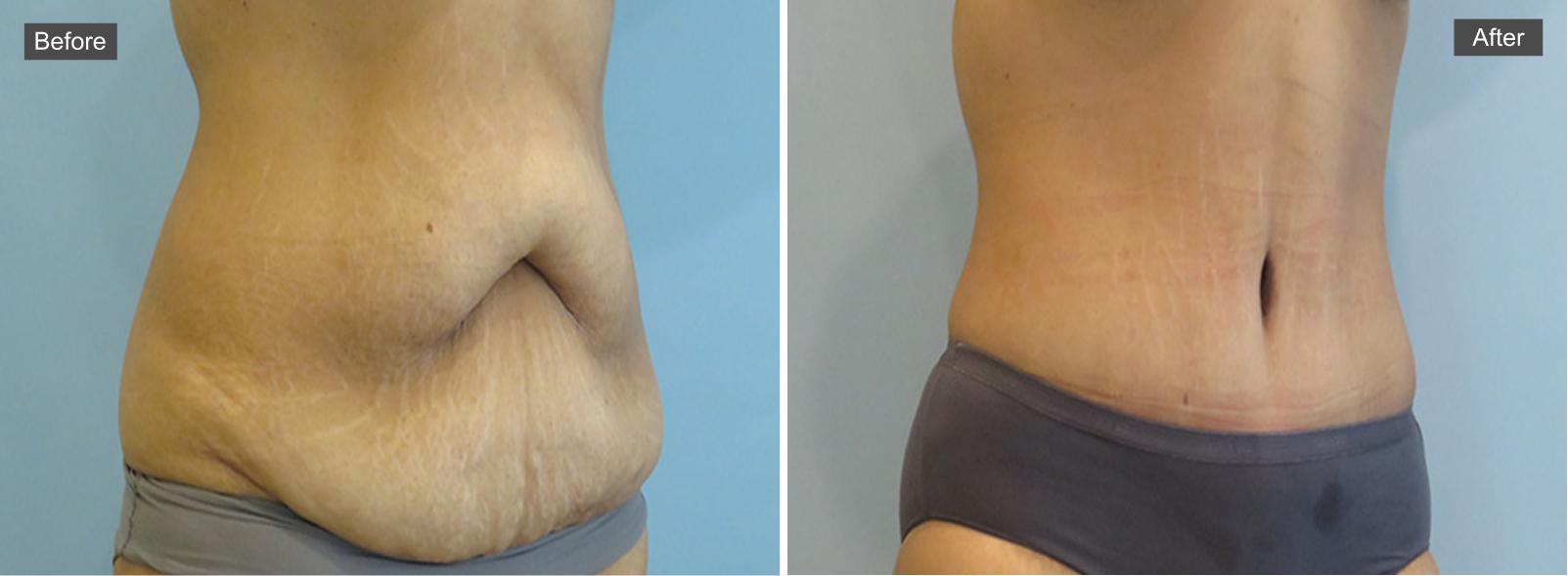 Before and after tummy tuck surgery showing abdominal skin tightening and contouring