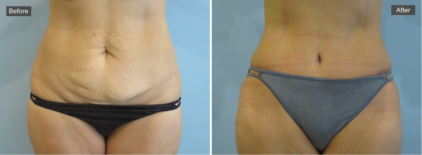 Before and after tummy tuck in Austin showing reduced abdominal skin laxity and improved waistline contour
