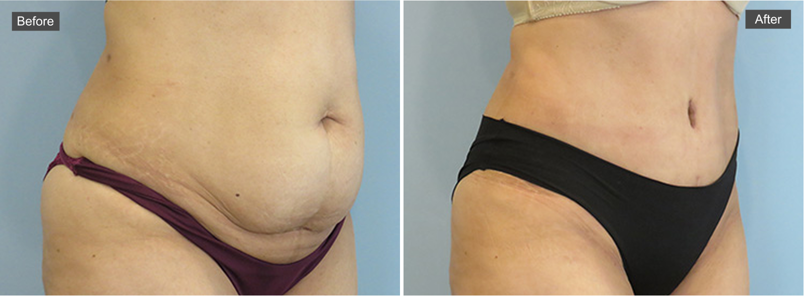 Before tummy tuck: abdomen with loose skin and fullness