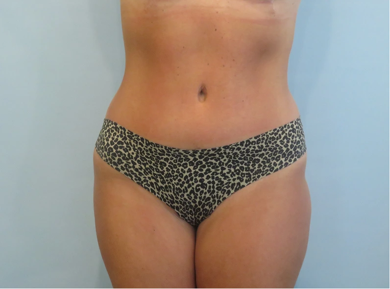 Patient's torso showing toned abdominal and hip contours after body contouring procedure