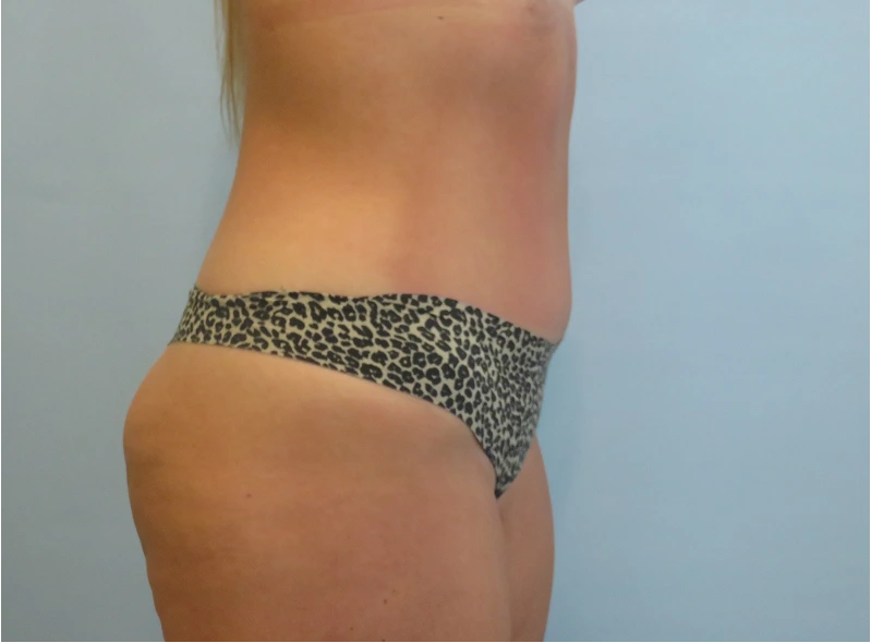 Patient's side profile showing buttocks and lower back after cosmetic procedure