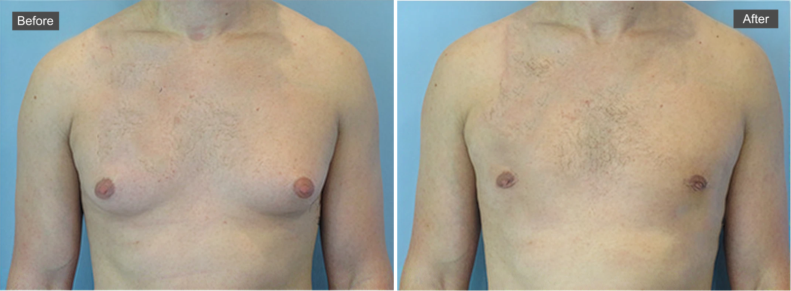 Before and after gynecomastia surgery showing reduced breast tissue and flattened chest contour