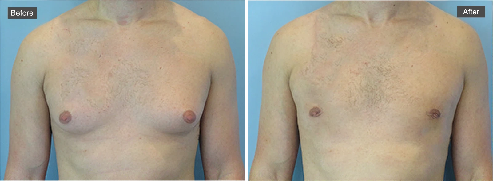 Before and after gynecomastia surgery showing reduced breast tissue and flattened chest contour