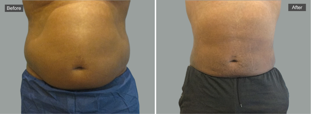 Before and after liposuction results showing abdominal contouring