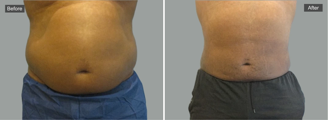 Before and after liposuction results showing abdominal contouring
