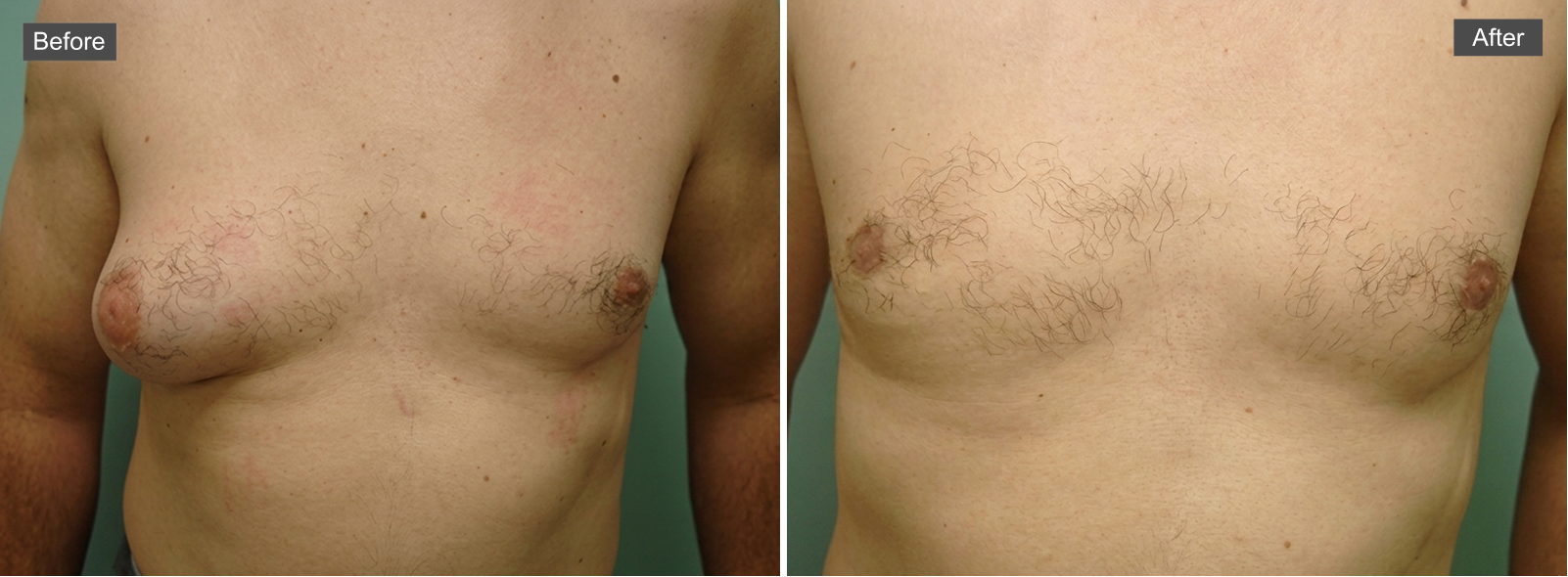 Before and after gynecomastia surgery: left shows enlarged breast tissue, right shows flattened chest contour