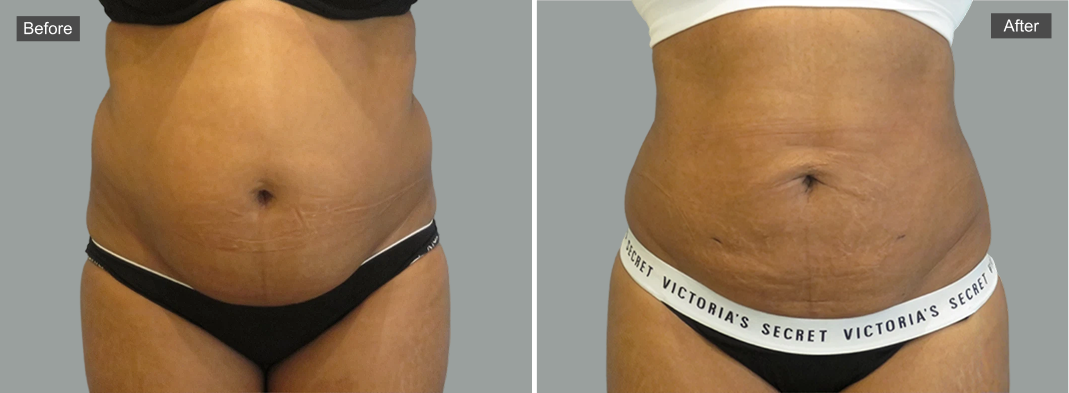 Before and after liposuction comparison showing reduced abdominal fullness and improved waistline definition