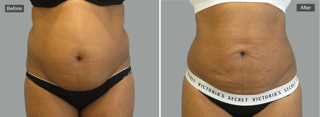 Before and after liposuction comparison showing reduced abdominal fullness and improved waistline definition