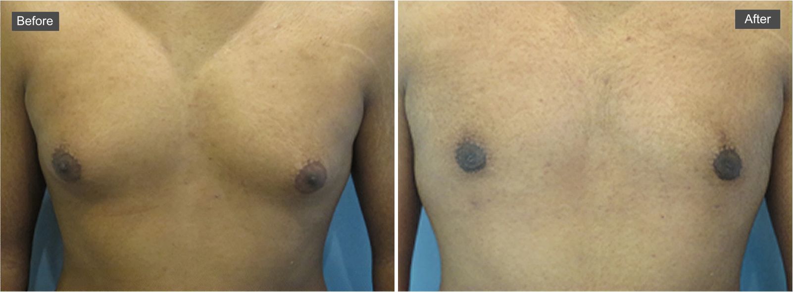 Before and after gynecomastia treatment showing male chest with reduced tissue and improved contour