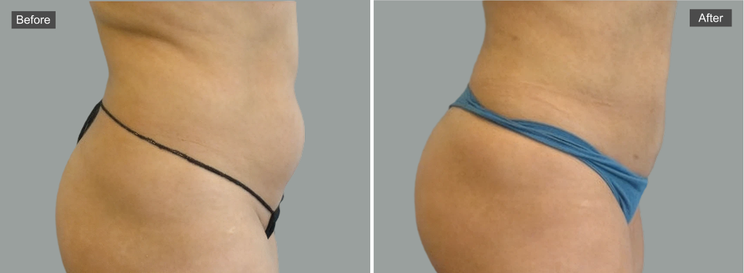 Before and after liposuction results showing reduced abdominal and flank contours