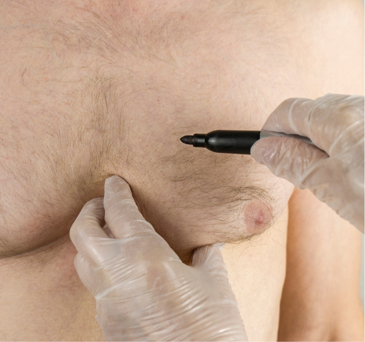 Healthcare provider in gloves marking male chest with surgical pen during gynecomastia consultation