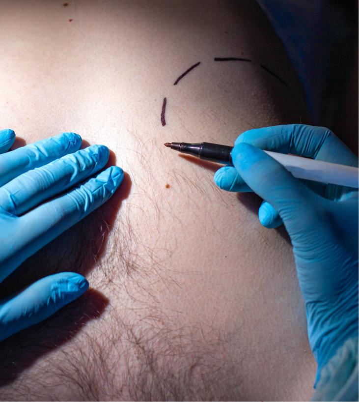 Surgeon in blue gloves marking incision lines on patient's chest with surgical marker for gynecomastia procedure
