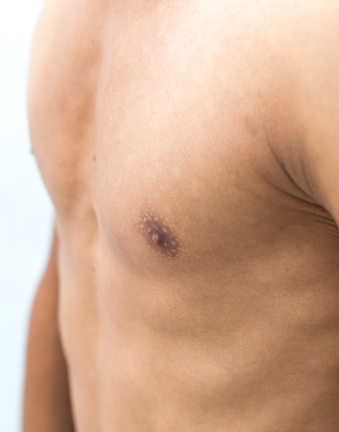 Male chest showing gynecomastia with breast tissue enlargement
