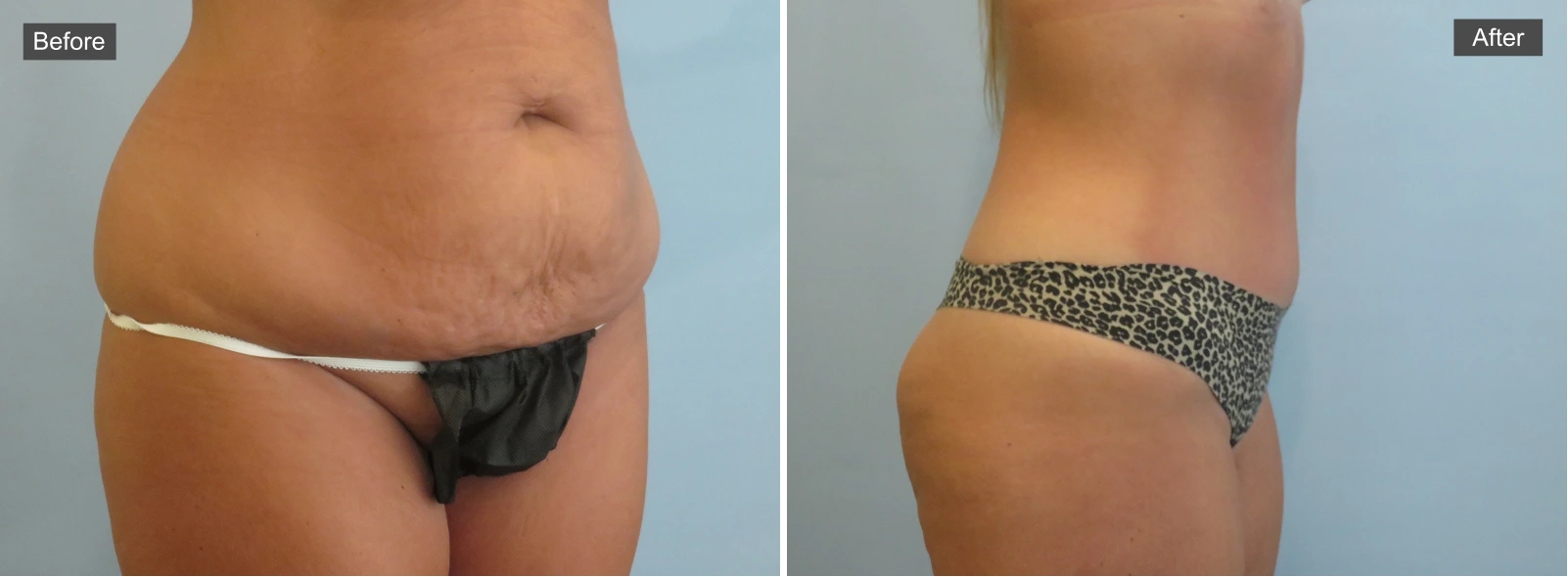 Before and after tummy tuck results showing abdominal contouring and skin tightening