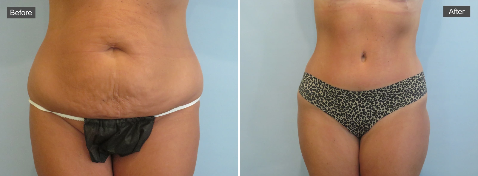 Before and after tummy tuck showing abdominal skin tightening and contouring