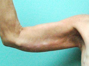 Arm Lift Before & After case 1