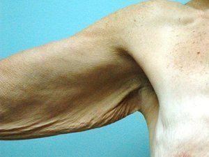 Arm Lift Before & After case 1