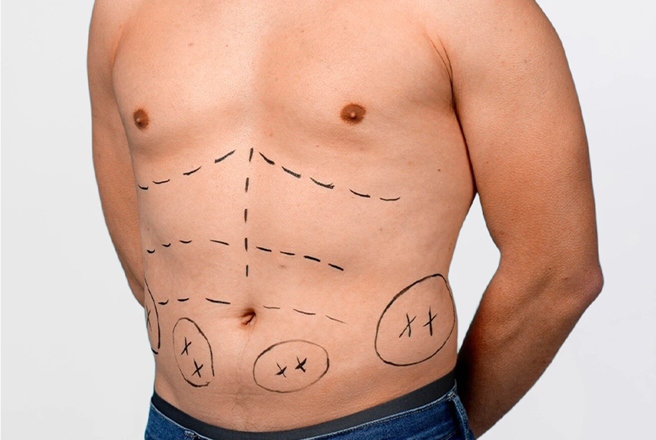 Austin TX Men’s Cosmetic Procedures: Male Liposuction Banner