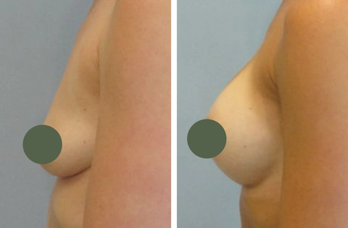 Before and After Breast Augmentation banner