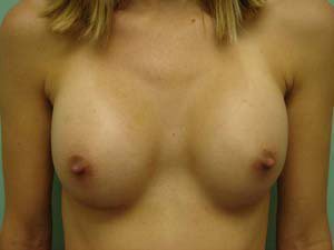 Breast Augmentation Before & After case 10