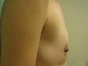 Breast Augmentation Before & After case 10